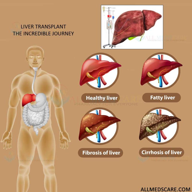 Liver Transplant