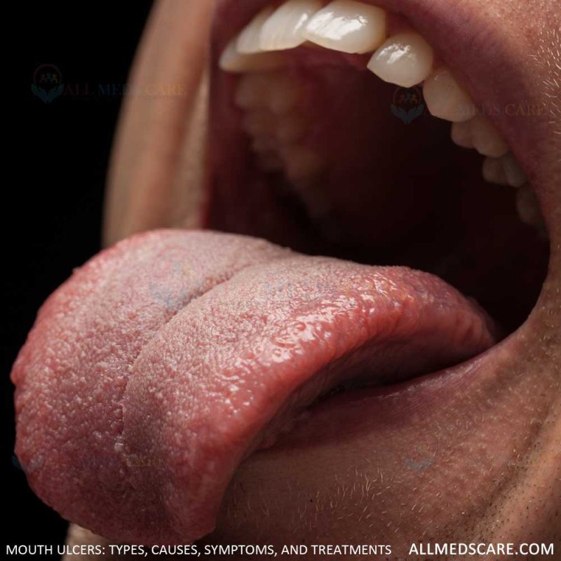 Mouth Ulcers types causes symptoms