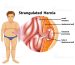 Untreated Hernia Precise hidden dangers