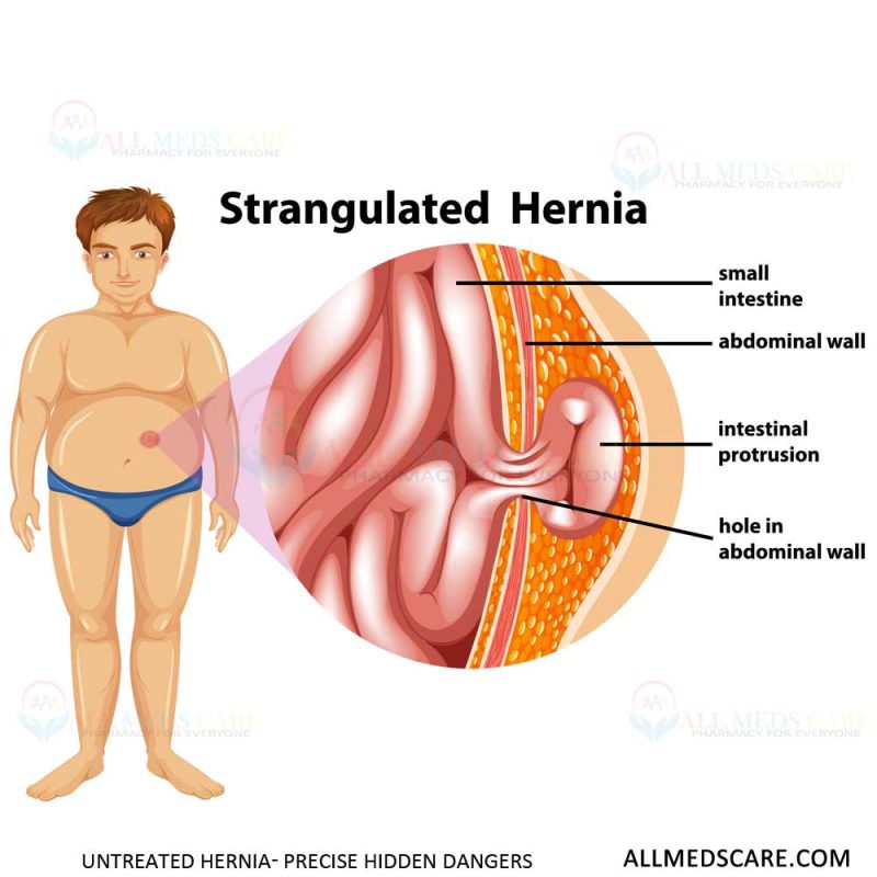 Untreated Hernia Precise hidden dangers