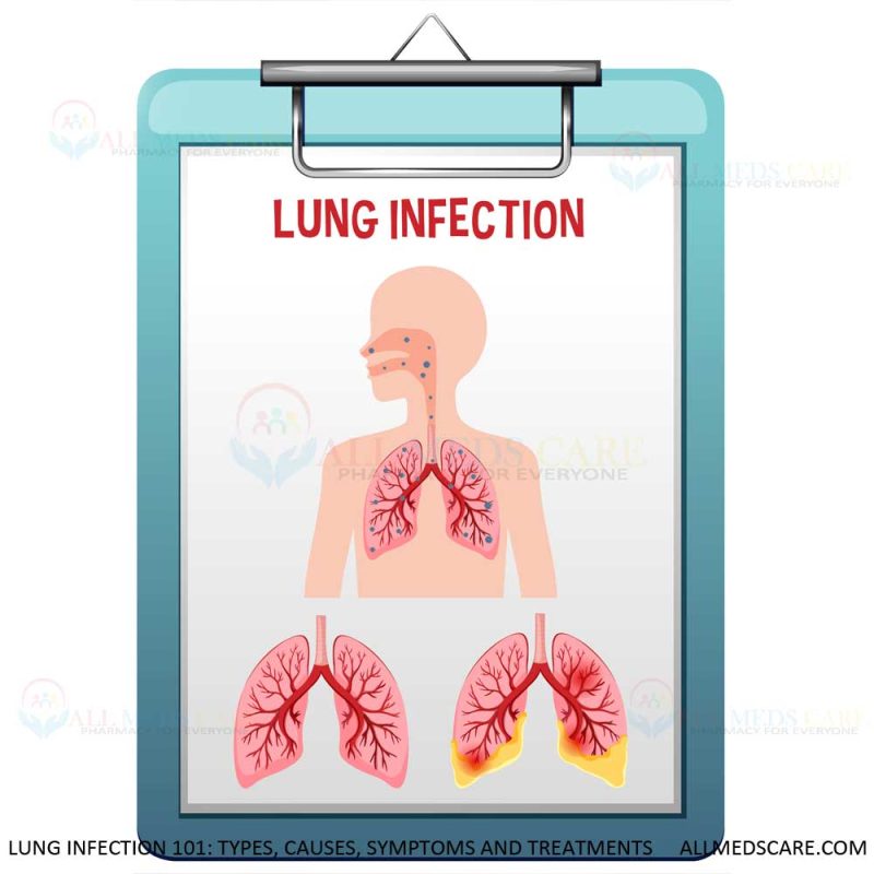 Lung Infection