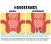 Hemorrhoids Piles Causes Symptoms