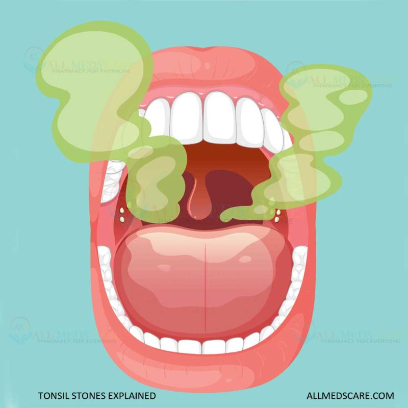 Tonsil Stones Explained